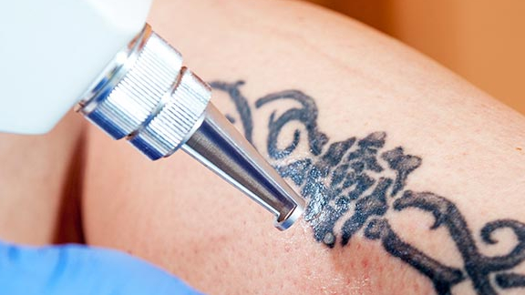 Tattoo removal 