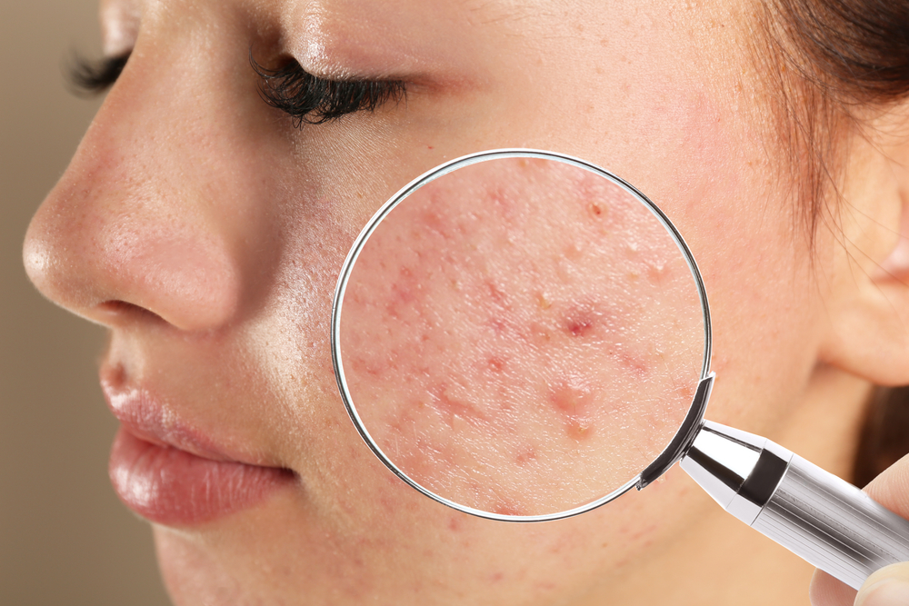 Acne scar removal 
